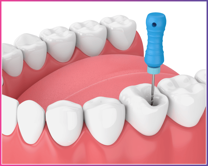 Dantų kanalų gydymas (endodontija)